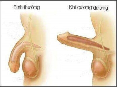 Dương vật không cương hết cỡ